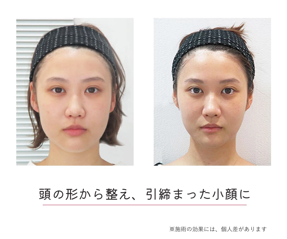 頭蓋骨矯正Before-After