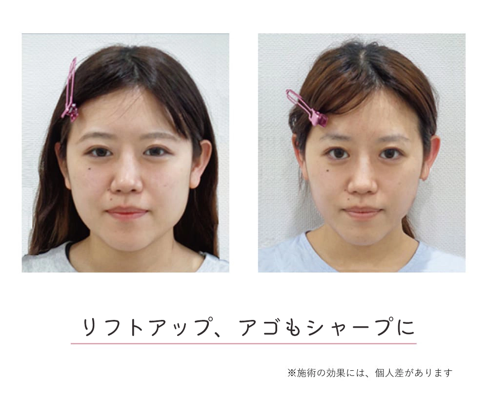 頭蓋骨矯正Before-After