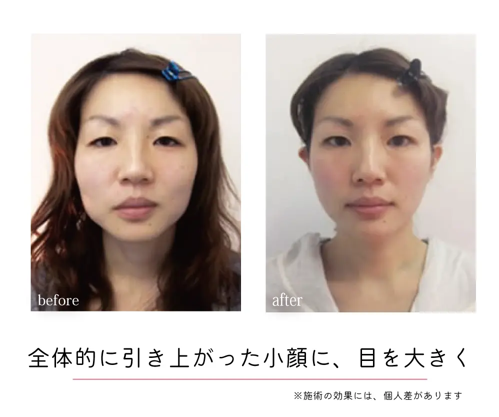 頭蓋骨矯正Before-After