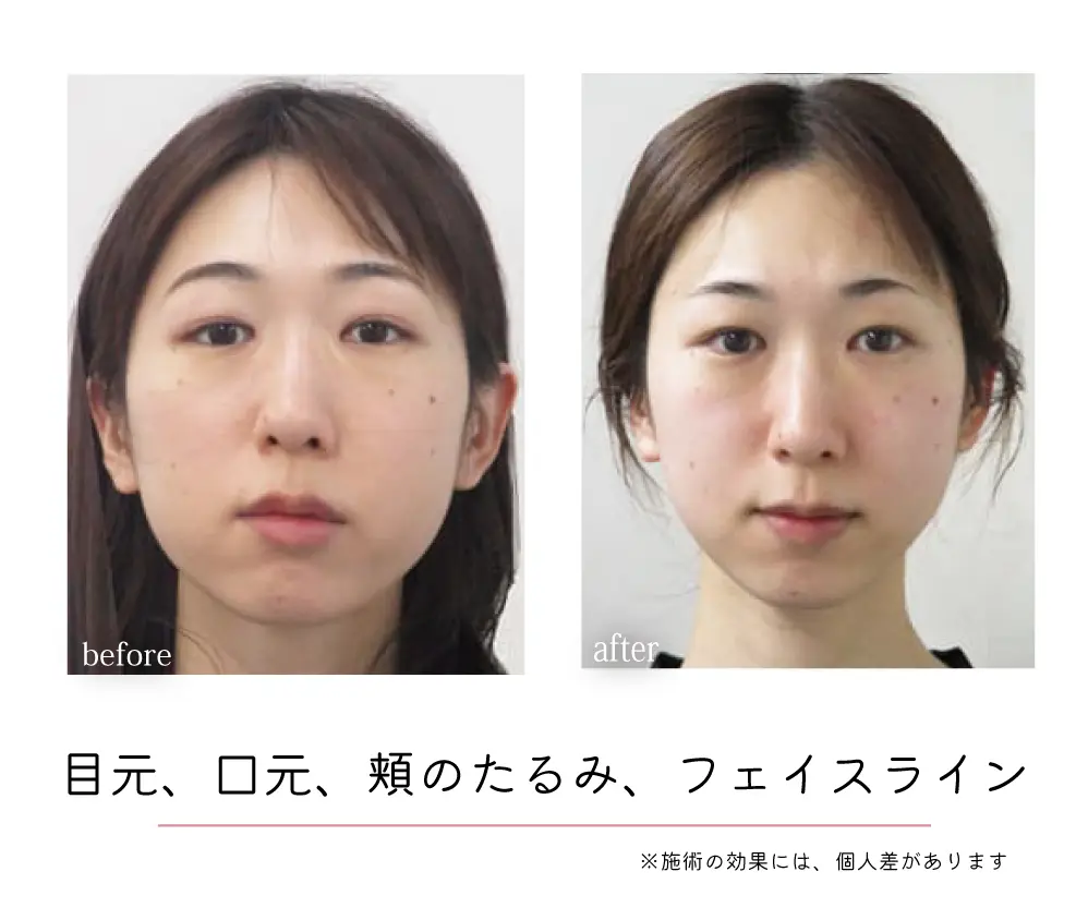 頭蓋骨矯正Before-After