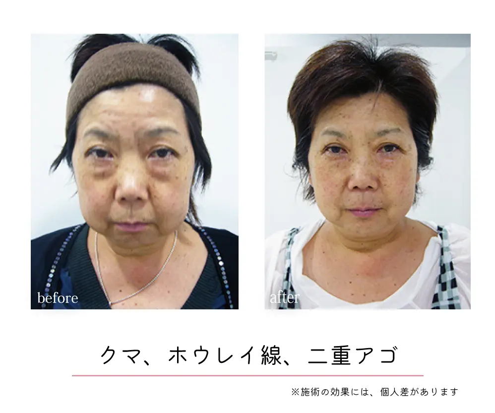 頭蓋骨矯正Before-After