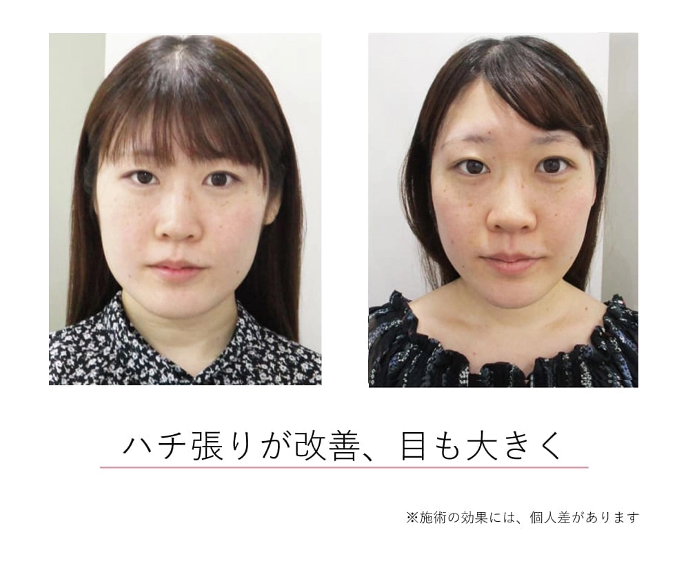 頭蓋骨矯正Before-After
