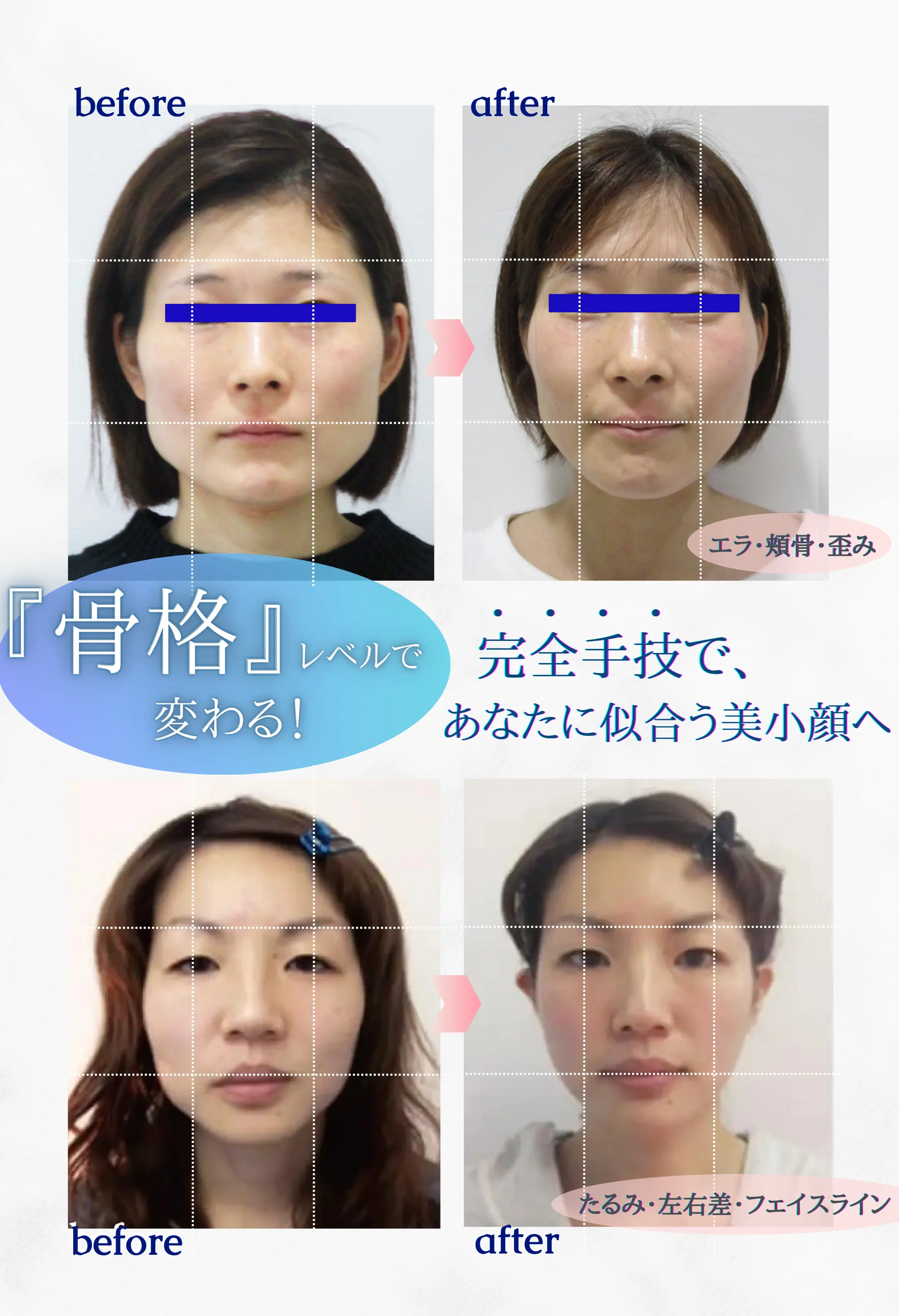小顔矯正Before-After
