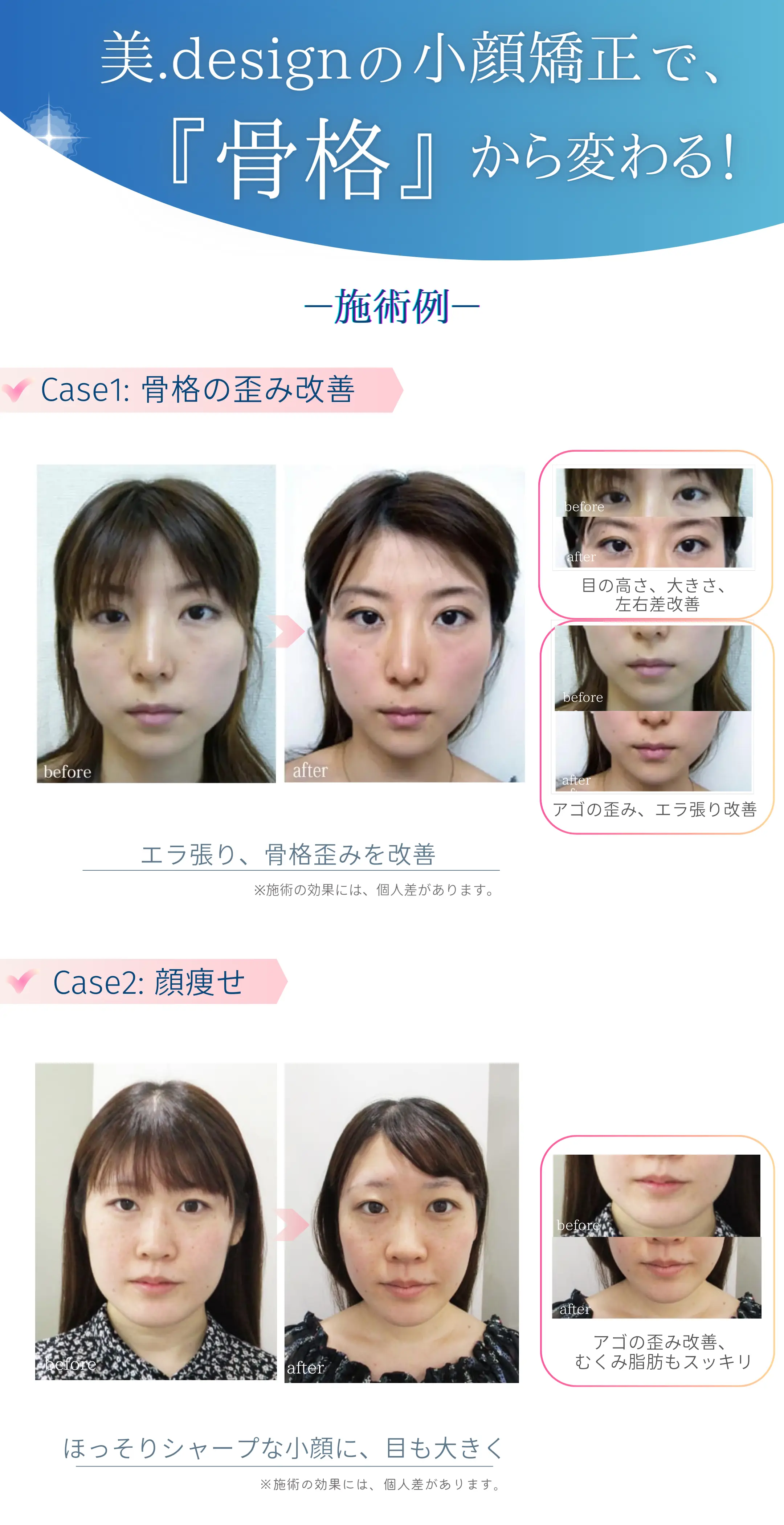 小顔矯正Before-After