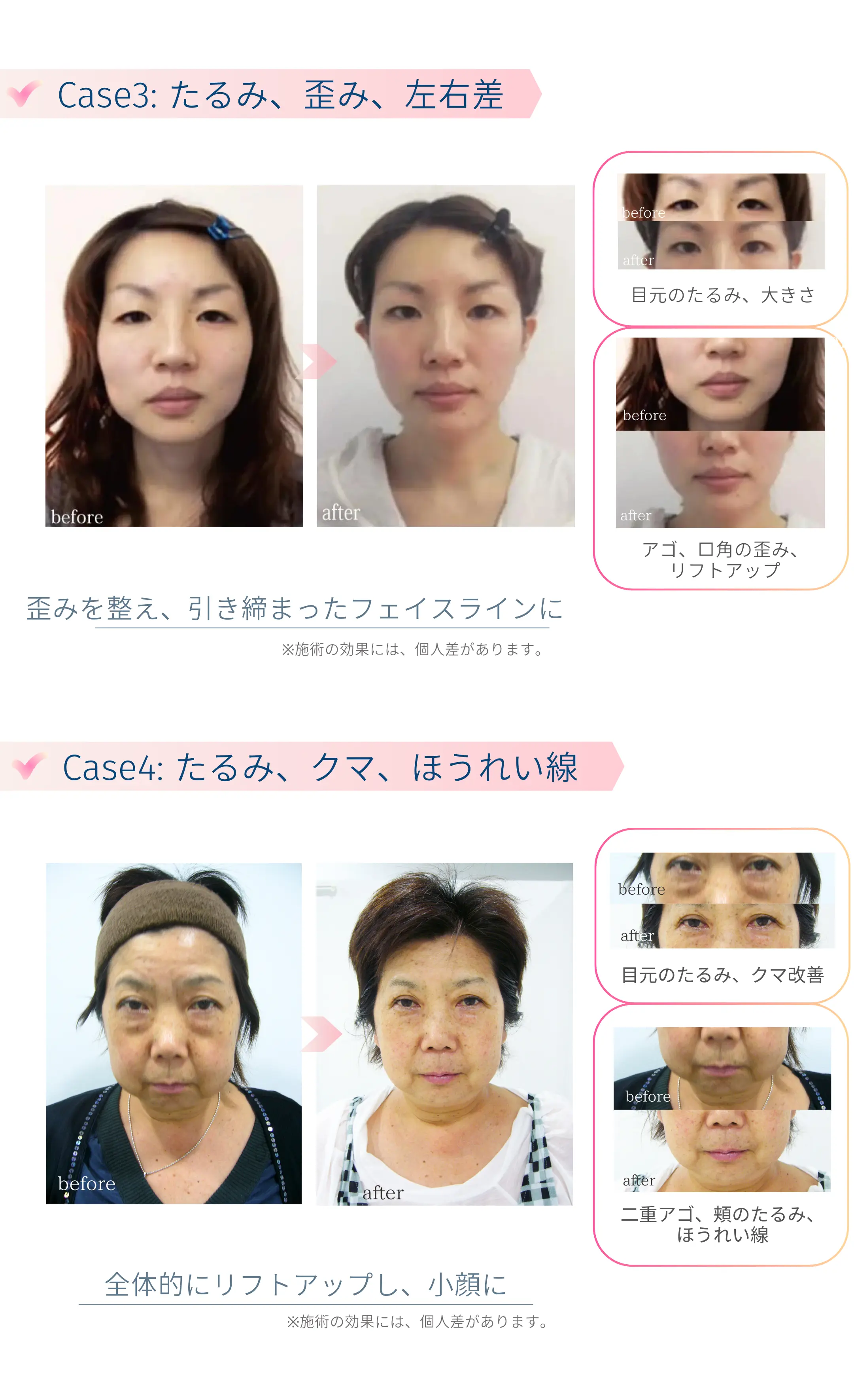 小顔矯正Before-After