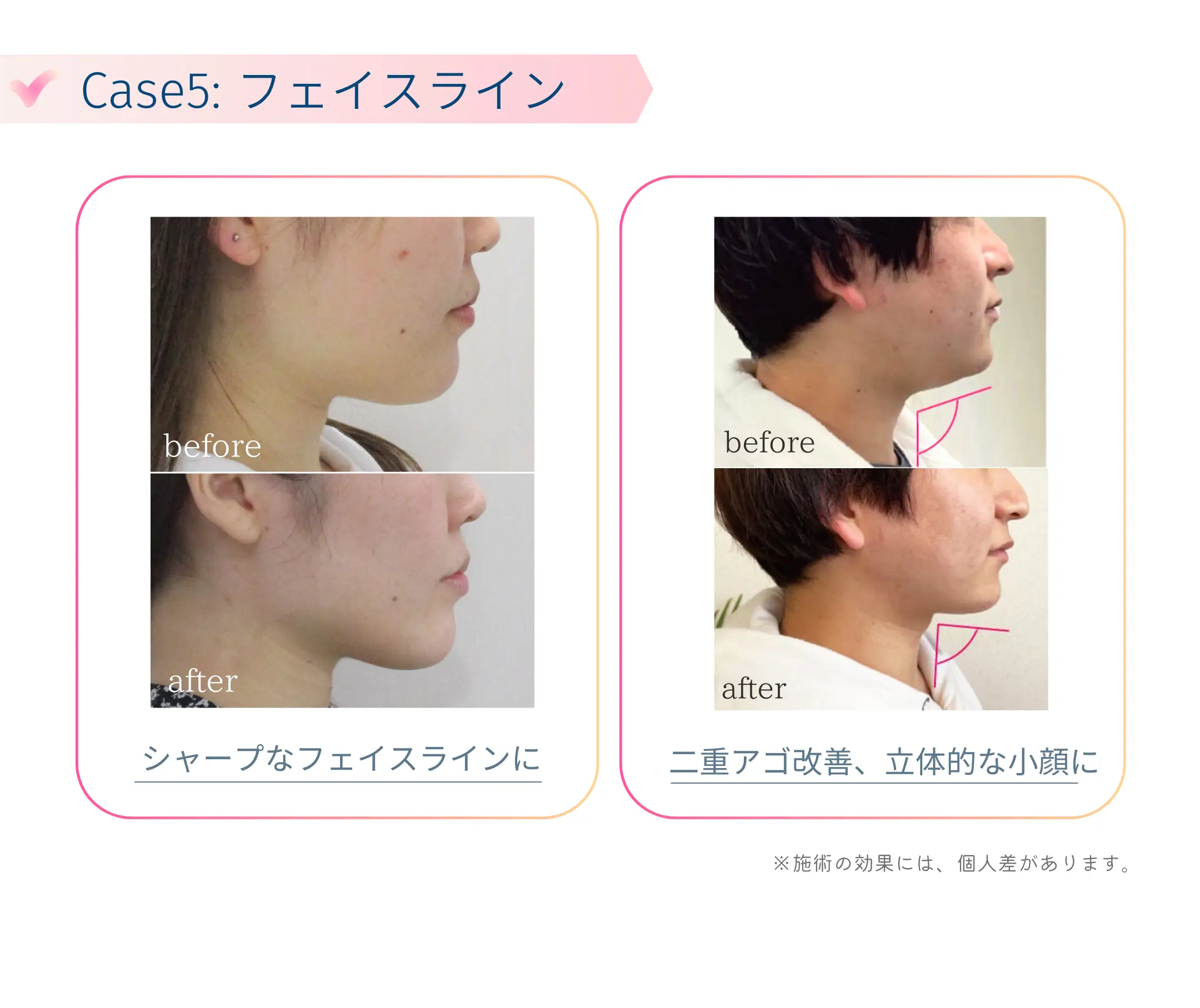 小顔矯正Before-After