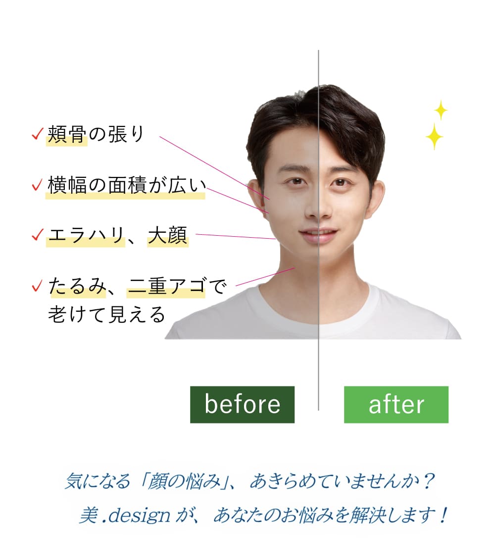 頬骨、横幅、エラ、大顔、たるみ、二重アゴ